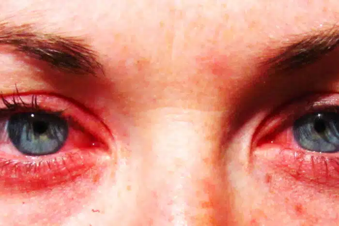 seasonal allergies, credit: Parrchristy, FlickrCC