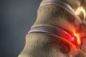 herniated disc